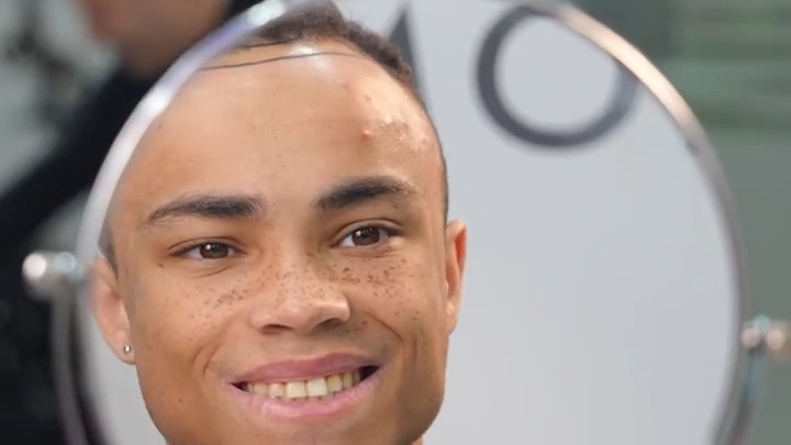 مقابلة زراعة الشعر 
